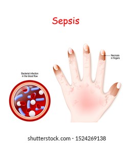Sepsis. Close-up of cross section of blood vessel with Bacterial infection. human hand with fingers necrosis. Vector illustration