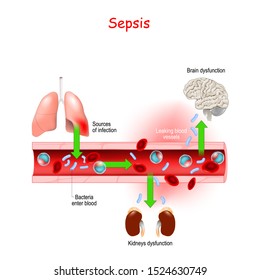 Sepsis. Close-up of cross section of blood vessel with Bacterial infection. septicaemia is a life-threatening illness. Effects of sepsis. Vector illustration