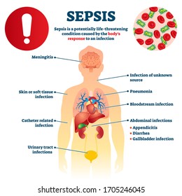 Sepsis vector illustration. Labeled infection condition educational scheme. Diagram with anatomical health symptoms and causes explanation. Body's response to bacteria illness and disease collection.