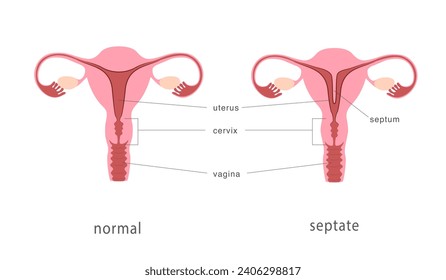 Estructura de útero humano normal y de setiembre. Septo uterino como malformación uterina congénita. Anatomía gráfica. Ilustración del vector