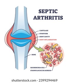 Septic arthritis joint inflammation with medical explanation outline diagram. Labeled educational scheme with leg bone anatomy and bacterial escherichia coli infection closeup vector illustration.