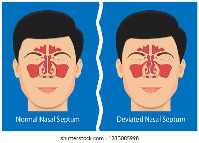 Septoplasty deviated nasal septum breath block blocked swell Nosebleed