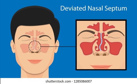 Septoplasty deviated nasal septum breath block blocked swell Nosebleed