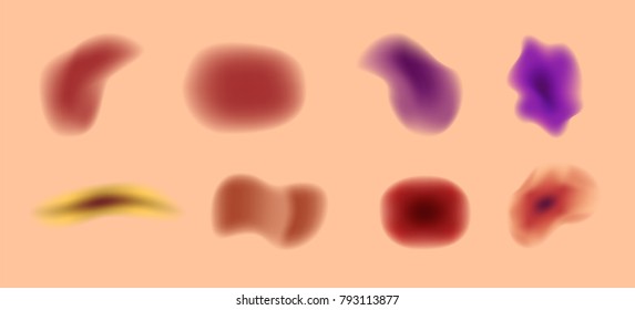 serious bruised . It bleeding in side the skin vector