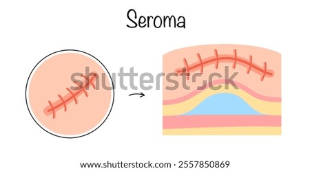 Seroma. One of the options for a postoperative complication, which is characterized by local accumulation of serous fluid. Drawn seroma formation after surgery. Color illustration for medical use.