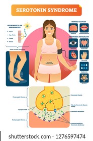 Serotonin Syndrome Vector Illustration With Medical Labeled Symptoms Scheme. Educational Diagram With Neuron Closeup And Anatomical Disease Explanation. Condition After Drugs Or Medications Overdose.