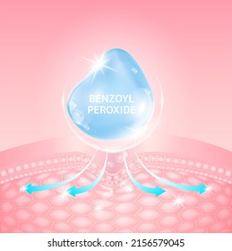 Serum Benzoyl Peroxide Blue. Collagen Hyaluronic Acid. Vitamin Solution Complex. Helps Dissolve Clogged Acne Reduce Inflammation Of Acne. Beauty Treatment Nutrition Skin Care Design. 3D Vector EPS10.