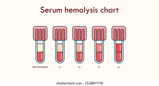 Serum hemolysis vector graphic chart for allied health science education