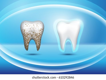 Set of 3d realistic dirty and clean tooth on blue backdrop,clearing tooth process.Oral care concept,teeth restoration.For mobile user interface,stomatology poster,placard and flyer