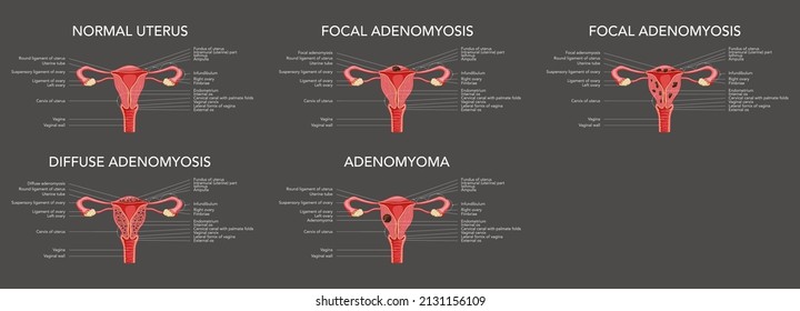 448 Labelled Uterus Images, Stock Photos & Vectors | Shutterstock