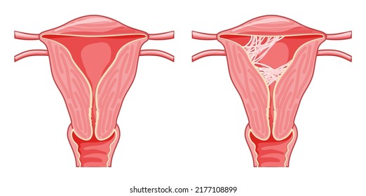 Set of Asherman syndrome Female reproductive system scar tissue adhesions in uterus. Front view in a cut. Sick and normal Human anatomy internal organs location scheme fallopian tube flat style icon