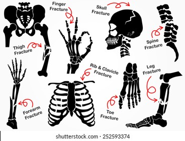 Set Bone Fracture Icon ( Pelvic , Hip , Thigh ( femur ) , Hand , Wrist , Finger , Skull , Face , Vertebra , Arm , Elbow , Thorax , Foot , Heel , Leg ) black & white design ( health care concept )