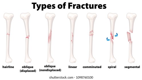 A Set of Bone Fractures illustration