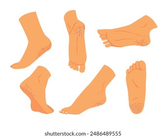 Set of callus cracked heels or feet, labelled plantar hyperkeratosis, Feet corns and calluses, medical condition, barefoot or foot fungus with various view or angles, isolated on white background