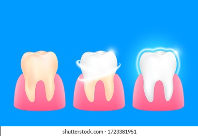 Set of  clean and dirty tooth. Step of yellow to white. Dental care concept, illustration isolated on blue background.