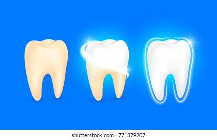 Set of  clean and dirty tooth. Step of yellow to white. Dental care concept, illustration isolated on blue background.