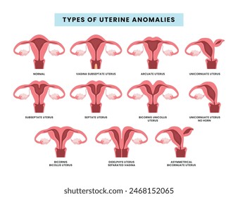 Set of Congenital anomalies of the female genital tract collection, Female reproductive system pathology. Gynecology defect medical for educational poster, vector illustration