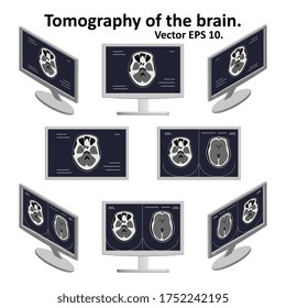 Set Of Cross Section Of The Brain During Magnetic Resonance Imaging On A Computer Screen In Isometric View. A Few Pictures Of The Image Of The Brain. MRI / CT Scan. Vector EPS10.