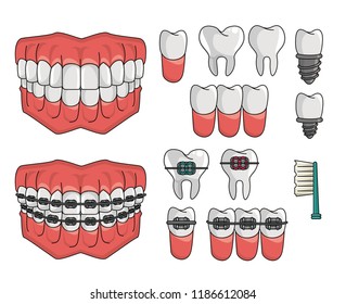 Set of dental braces elements