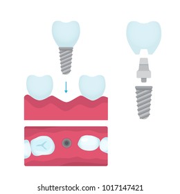 Set von Zahnkronen und Implantationsprosthodontika Elemente und Werkzeuge. Vektorillustration flach.