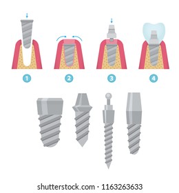 Set Of Dental Crowns And Implantation Prosthodontics Elements And Tools. Vector Flat Illustration.