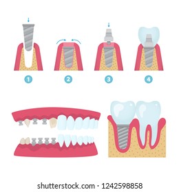 Conjunto de coronas dentales y elementos y herramientas de prótesis de implantación. Ilustración plana vectorial.