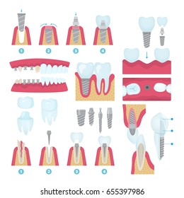 Set of dental crowns and implantation prosthodontics elements and tools. Vector flat illustration.