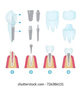 Set of dental crowns and implantation prosthodontics elements and tools. Vector flat illustration.