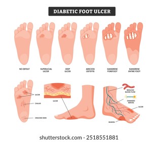 Conjunto de úlcera alimentaria diabética 
Infografía médica Diseño de carteles de atención médica para la educación, etapas etiquetadas de úlcera en el pie, diabetes necrosis de gangrena Neuropatía Herida Fascitis necrosante Infarto Frost