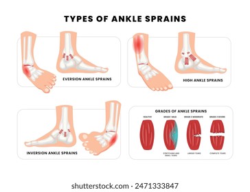 Set of different types of ankle sprains banner, foot medical injury levels diagram medical poster for education, Anatomical leg problem significance measurement and division illustration.