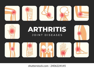 Set of different types of Arthritis infographic poster, Joint disease pain in human body, Types of joint pain medical poster, Inflammatory Rheumatoid Arthritis, healthy lifestyle concept.