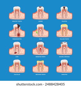 Set of different types of dental disease medical poster collection, Treatment of the oral cavity. Toothache, Dentistry oral problem educational infographic set with caries, inflammation, flux, enamel.