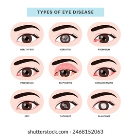 Set of different types of eye disease collection, Ophthalmology health illustration with Keratitis, pterygium, pingueculum, blepharitis, conjunctivitis, stye, cataract, glaucoma. vector illustration.