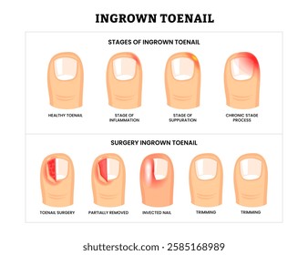 Set different types of ingrown toenail collection with ingrown toenail stages and surgery infographic, partially removed nail , foot disease, infected nail and trimming, isolated on white background.