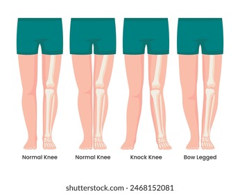 Set different types of Shapes of the legs. Normal and curved legs. Knock knees. Bowed legs. Genu valgum and genu varum. For advertising, medical, health care education publication poster or banner.