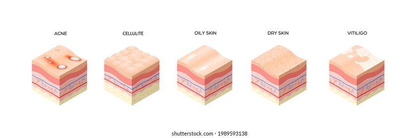 set different types skin layers cross-section of human skin structure skincare medical concept flat horizontal