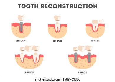 Set of diffrent human teeth reconstruction kind. Tooth loss and repacement. Idea of dental health and medical treatment. Isolated illustration in cartoon style