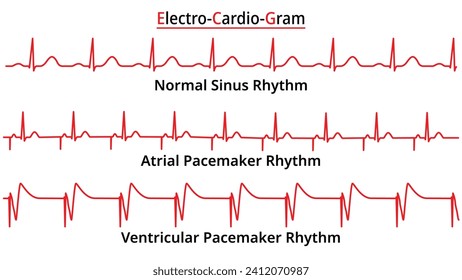Set of ECG Common Abnormalities - Atrial vs Ventricular Pacemaker Rhythm - Single Chamber - Electrocardiogram Vector Medical Illustration
