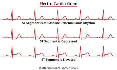 Set of ECG Common Abnormalities - Elevated ST Segment vs Depressed ST Segment - Normal Sinus Rhythm - Medical Vector and Illustration