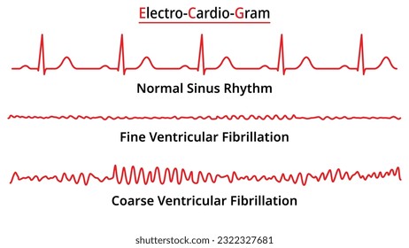 Set of ECG Common Abnormalities - Fine vs Coarse Ventricular Fibrillation (VF) - Normal Sinus Rhythm - Electrocardiography Vector Medical Illustration