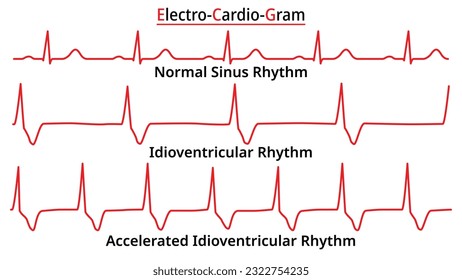 Set of ECG Common Abnormalities - Idioventricular Rhythm vs Accelerated (AIVR) - Normal Sinus Rhythm - Electrocardiography Vector Medical Illustration