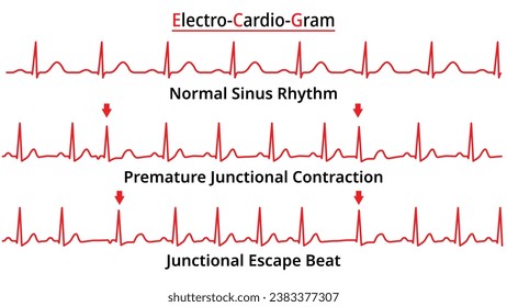 Set of ECG Common Abnormalities - Junctional Escape Beat - Premature Junctional Contraction PJC - Electrocardiogram Vector Medical Illustration