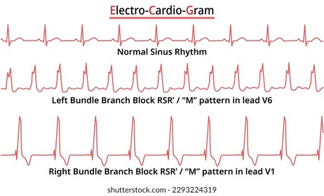 Set of ECG Common Abnormalities - Left Bundle Branch Block vs Right Bundle Branch Block - Normal Sinus Rhythm - Medical Vector Illustration