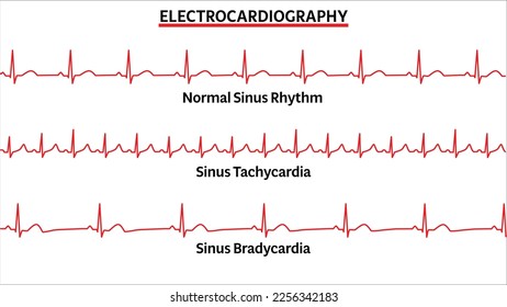 Set of ECG Common Abnormalities - Normal Sinus Rhythm - Sinus Tachycardia - Sinus Bradycardia - Vector Medical Illustration