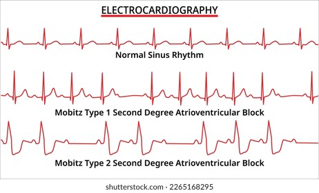 Set of ECG Common Abnormalities - Normal Sinus Rhythm - Mobitz Type 1 and 2 - Second Degree Atrioventricular (AV) Block - Electrocardiography Vector Medical Illustration