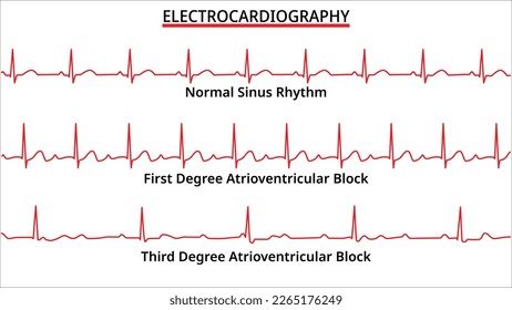 Conjunto de anomalías comunes del ECG - Ritmo sinusal normal - Bloque auriculoventricular de primer y tercer grado (AV) - Ilustración médica del vector electrocardiográfico