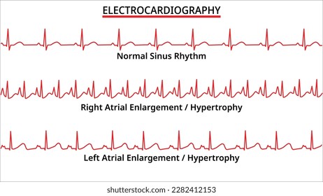 Set of ECG Common Abnormalities - Right Atrial Enlargement or Hypertrophy vs Left Atrial Enlargement or Hypertrophy - Normal Sinus Rhythm