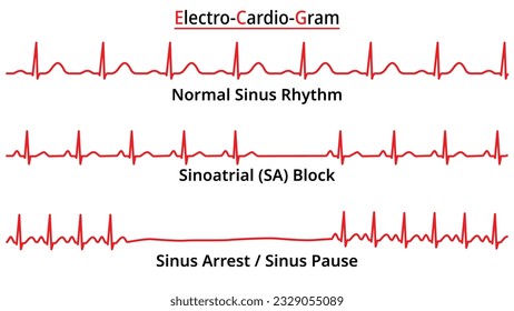 Reihe von EKG-gemeinsamen Anomalien - Sinoatrial (SA) Block - Sinus Arrest - Sinus Pause - Elektrokardiographische Vektormedizinische Illustration