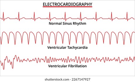 Set of ECG Common Abnormalities - Ventricular Tachycardia vs Ventricular Fibrillation - Normal Sinus Rhythm - Electrocardiography Vector Medical Illustration