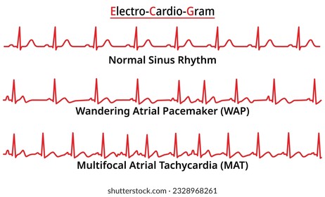 Reihe von EKG-Häufig Anomalien - Wanderender Profispastenmacher (WAP) - Multifofofofokale Atrialtridtachykardie (MAT) - Elektrokardiographische Vektormedizinische Illustration